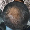 Comprender la ciencia detrás de la pérdida de cabello: causas y soluciones